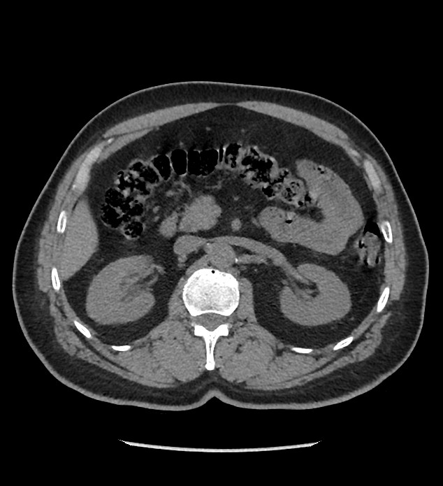 Chromophobe renal cell carcinoma (Radiopaedia 86879-103083 Axial non-contrast 35).jpg