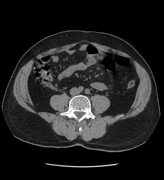 Chromophobe renal cell carcinoma (Radiopaedia 86879-103083 Axial non-contrast 70).jpg