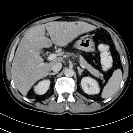 Chronic appendicitis complicated by appendicular abscess, pylephlebitis and liver abscess (Radiopaedia 54483-60700 B 50).jpg