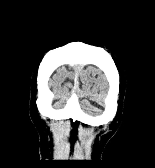 Chronic bilateral subdural hygroma (Radiopaedia 85801-101623 B 13).jpg