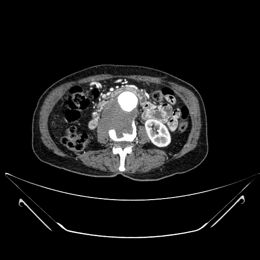 File:Chronic contained rupture of abdominal aortic aneurysm with extensive erosion of the vertebral bodies (Radiopaedia 55450-61901 A 28).jpg