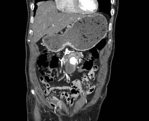 Chronic contained rupture of abdominal aortic aneurysm with extensive erosion of the vertebral bodies (Radiopaedia 55450-61901 D 8).jpg