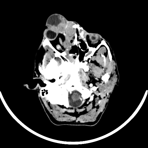 Chronic invasive fungal sinusitis with intraorbital and intracranial extension (Radiopaedia 56387-63046 B 73).jpg