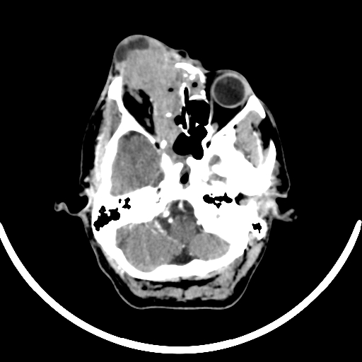 Chronic invasive fungal sinusitis with intraorbital and intracranial extension (Radiopaedia 56387-63046 B 93).jpg