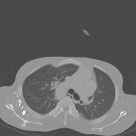 Chronic large bowel pseudo-obstruction (Radiopaedia 43181-46492 Axial bone window 3).jpg