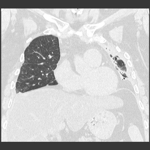 Chronic lung allograft dysfunction - restrictive form (Radiopaedia 60595-68316 Coronal lung window 43).jpg