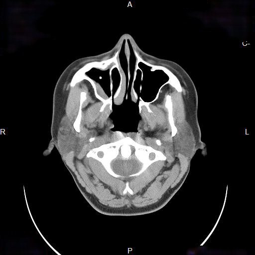 File:Chronic maxillary sinusitis with a foreign body (dental filling material) (Radiopaedia 7811-8639 Axial non-contrast 3).jpg