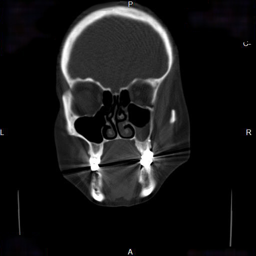 File:Chronic maxillary sinusitis with a foreign body (dental filling material) (Radiopaedia 7811-8639 Coronal bone window 6).jpg