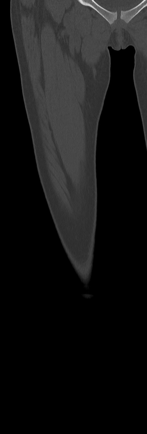 Chronic ostemyelitis of the femur with long sinus tract (Radiopaedia 74947-85982 Coronal bone window 20).jpg