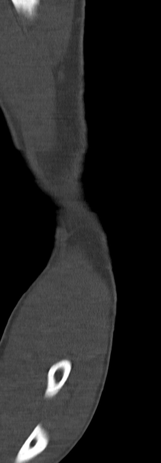 Chronic osteomyelitis of the distal humerus (Radiopaedia 78351-90971 Sagittal bone window 30).jpg
