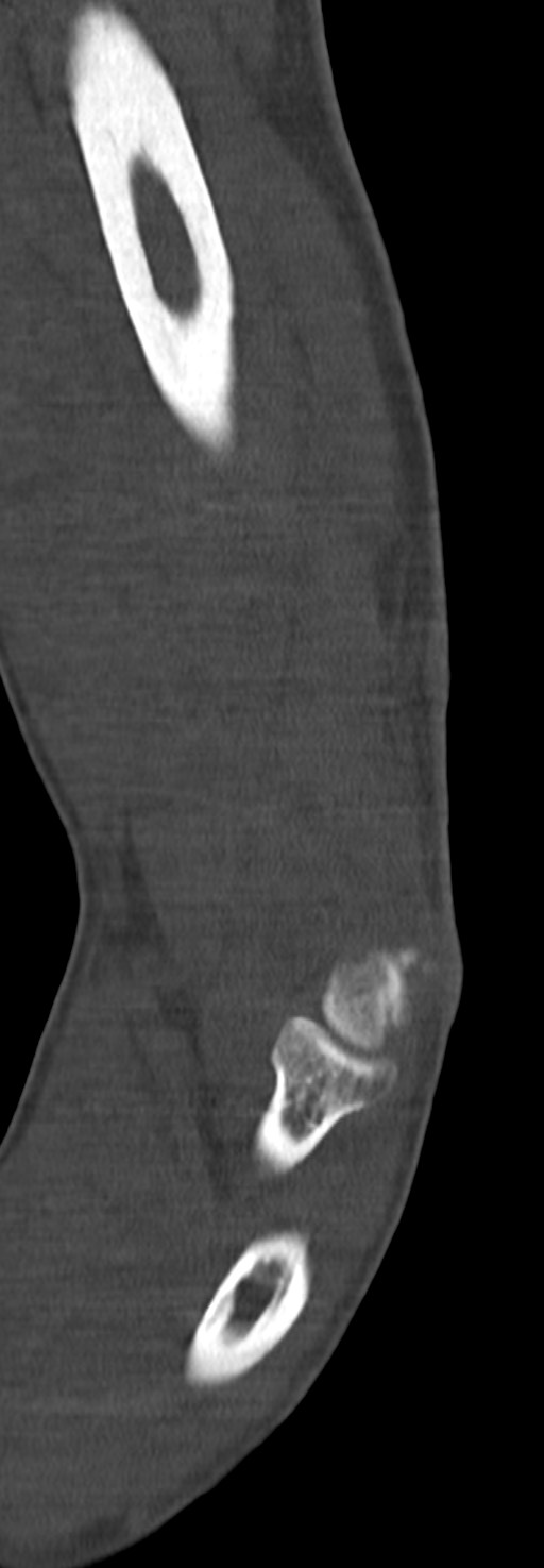 Chronic osteomyelitis of the distal humerus (Radiopaedia 78351-90971 Sagittal bone window 42).jpg
