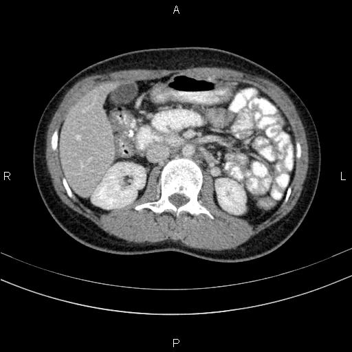 File:Chronic pancreatitis (Radiopaedia 64576-73450 C 69).jpg