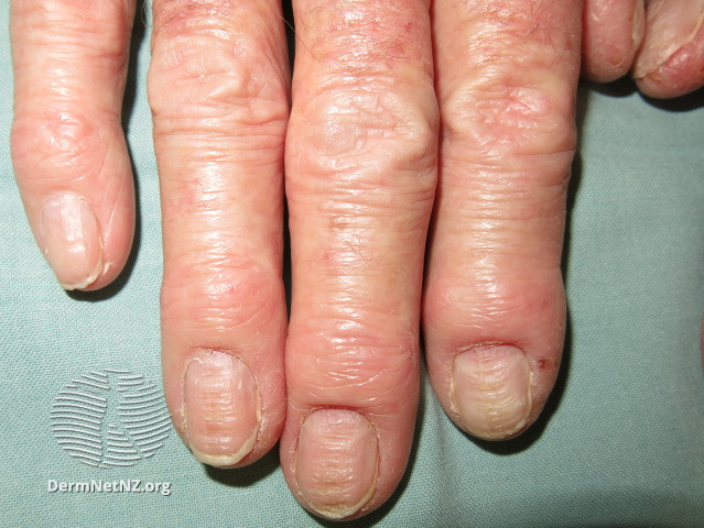 File:Chronic paronychia and hand dermatitis (DermNet NZ chronic-paronychia).jpg