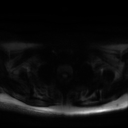 Chronic submandibular sialadenitis (Radiopaedia 61852-69885 Axial DWI 30).jpg