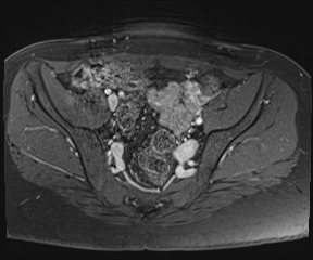 File:Class II Mullerian duct anomaly- unicornuate uterus with rudimentary horn and non-communicating cavity (Radiopaedia 39441-41755 Axial T1 fat sat 36).jpg