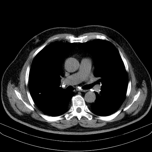 File:Classic complicated silicosis (Radiopaedia 49720-54961 Axial liver window 26).jpg