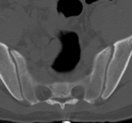 Clear cell meningoma - lumbar spine (Radiopaedia 60116-67691 Axial bone window 79).png