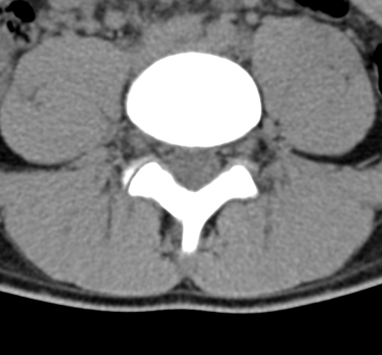Clear cell meningoma - lumbar spine (Radiopaedia 60116-67691 Axial non-contrast 53).png