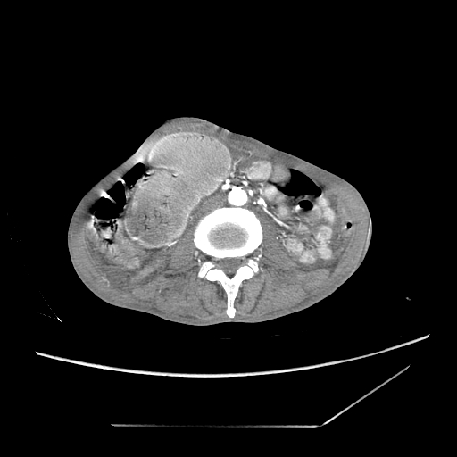 Closed-loop obstruction due to peritoneal seeding mimicking internal hernia after total gastrectomy (Radiopaedia 81897-95864 A 106).jpg