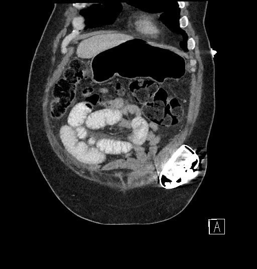 Closed loop obstruction - internal hernia into nephrectomy bed (Radiopaedia 59867-67320 B 17).jpg