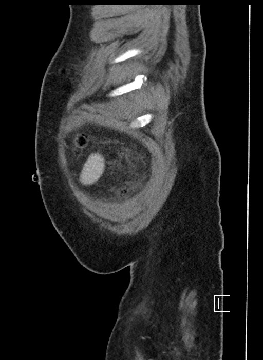 Closed loop obstruction - internal hernia into nephrectomy bed (Radiopaedia 59867-67320 C 105).jpg