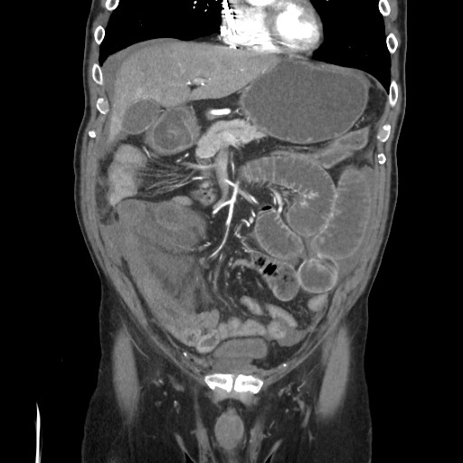Closed loop obstruction due to adhesive band, resulting in small bowel ischemia and resection (Radiopaedia 83835-99023 C 46).jpg