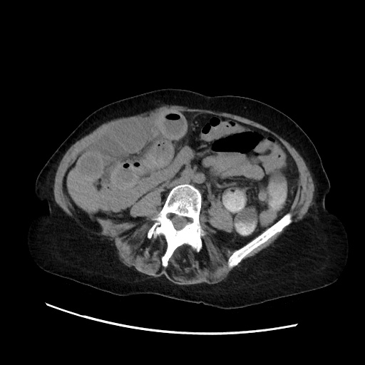 Closed loop small bowel obstruction due to adhesive band, with intramural hemorrhage and ischemia (Radiopaedia 83831-99017 Axial non-contrast 91).jpg