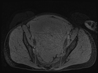 Closed loop small bowel obstruction in pregnancy (MRI) (Radiopaedia 87637-104031 G 2).jpg