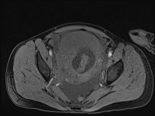 Closed loop small bowel obstruction in pregnancy (MRI) (Radiopaedia 87637-104031 G 6).jpg
