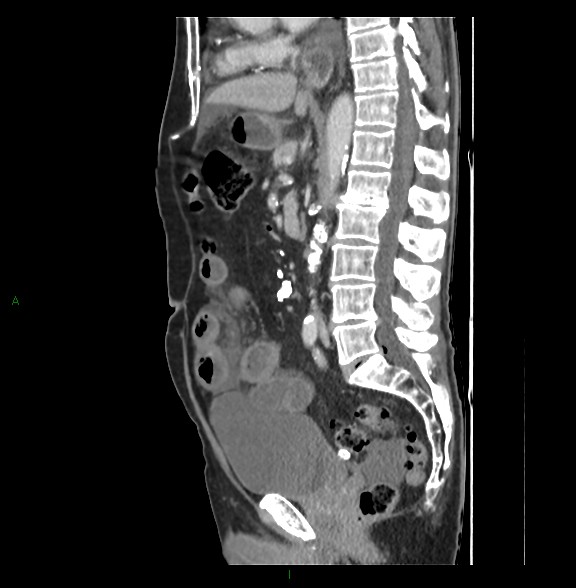 Closed loop small bowel obstruction with ischemia (Radiopaedia 84180-99456 C 47).jpg