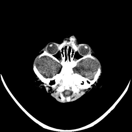 File:Cloverleaf shaped skull in the absence of craniosynostosis (Radiopaedia 21296-21216 Axial non-contrast 1).jpg