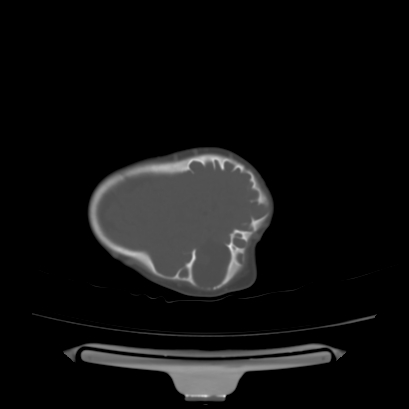 Cloverleaf skull (Radiopaedia 91901-109710 Axial bone window 130).jpg