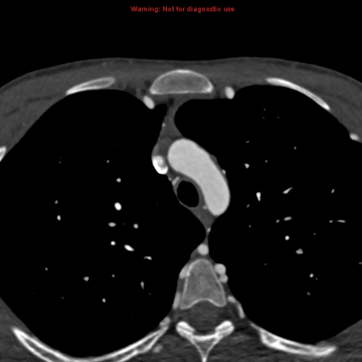 File:Coarctation of the aorta (Radiopaedia 12461-12697 A 45).jpg