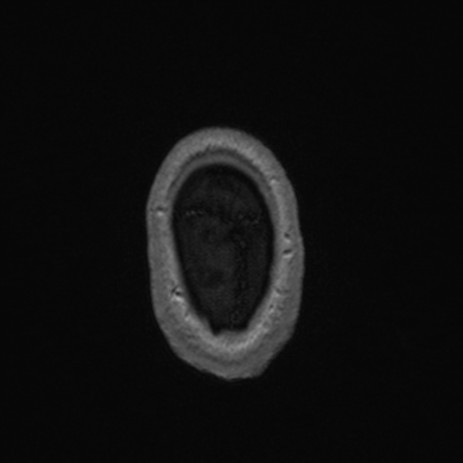 Colloid cyst (Radiopaedia 44510-48181 Axial T1 C+ 172).png