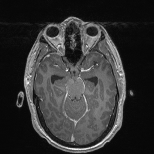 File:Colloid cyst (Radiopaedia 44510-48181 Axial T1 C+ 73).png