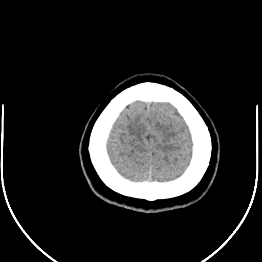 Colloid cyst (Radiopaedia 52865-58792 Axial non-contrast 12).jpg