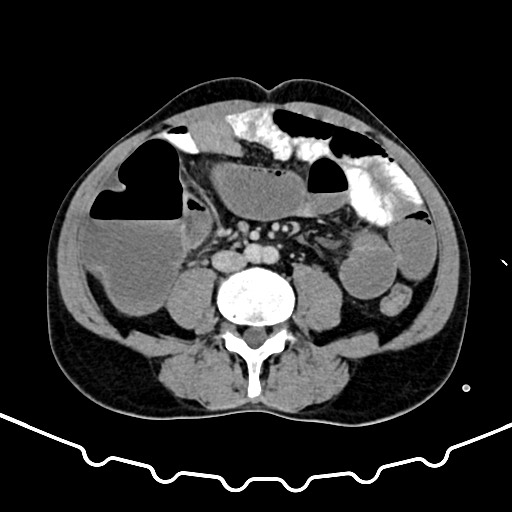 Colocolic intussusception due to large lipoma (Radiopaedia 68773-78482 A 112).jpg