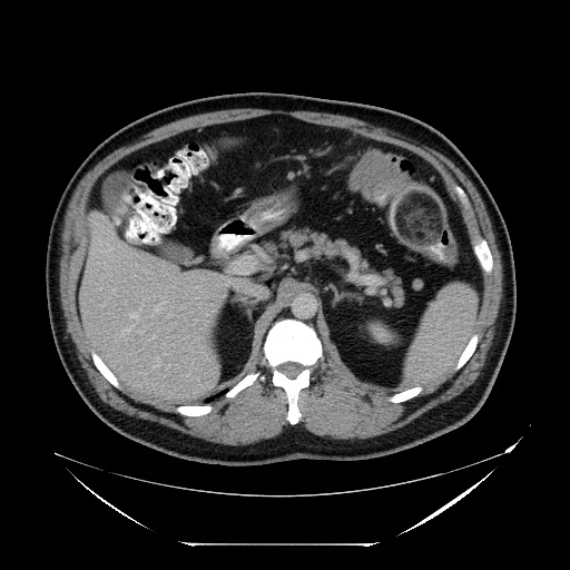 Colocolic intussusception due to lipoma (Radiopaedia 73712-84508 A 34).jpg