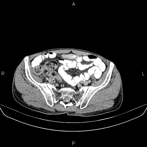 File:Colon adenocarcinoma - hepatic flexure (Radiopaedia 85635-101395 Axial C+ delayed 74).jpg