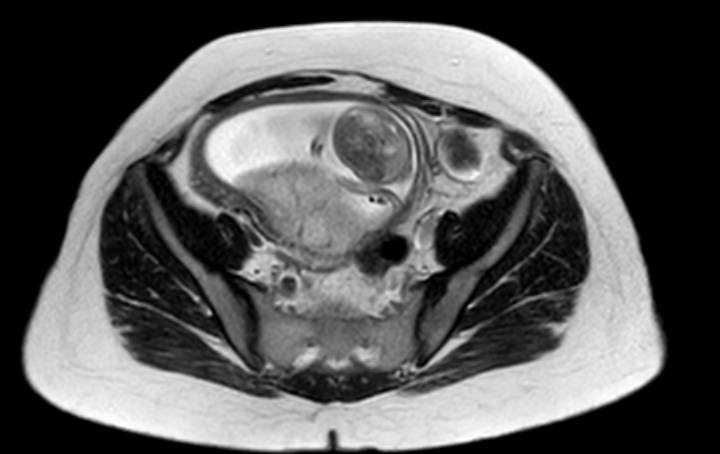 File:Colon adenocarcinoma with Krukenberg tumors, advanced pregnancy (Radiopaedia 67279-76645 Axial T2 20).jpg