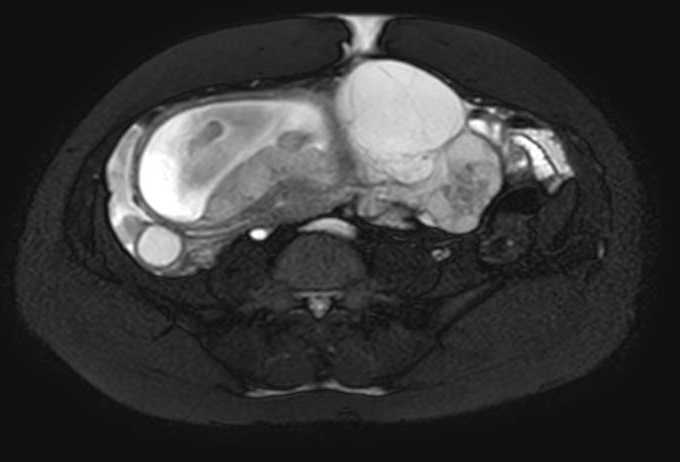 Colon adenocarcinoma with Krukenberg tumors, advanced pregnancy (Radiopaedia 67279-76645 Axial T2 SPAIR 32).jpg