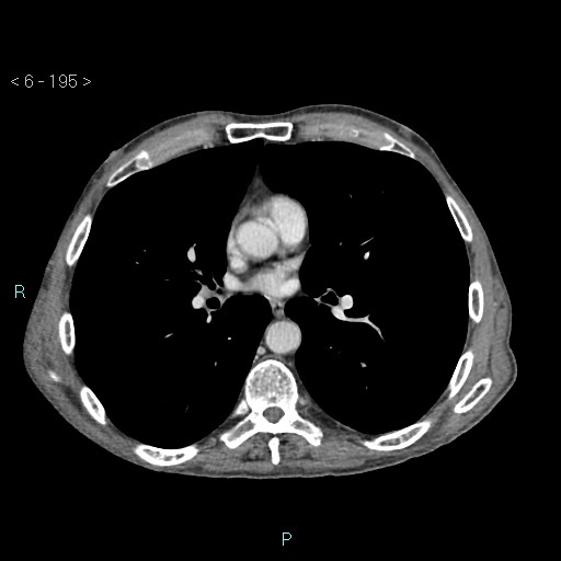 File:Colonic cancer (ultrasound and TC imaging) (Radiopaedia 50346-55713 B 195).jpg
