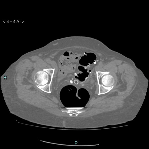 Colonic lipomas (Radiopaedia 49137-54244 Axial bone window 188).jpg