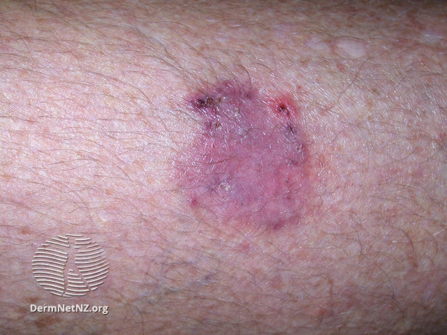 Intraepidermal carcinoma (DermNet NZ lesions-scc-in-situ-2913).jpg