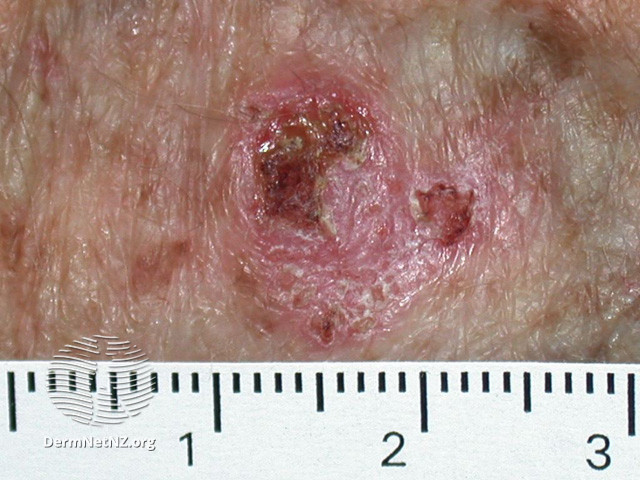 File:Intraepidermal carcinoma (DermNet NZ lesions-scc-in-situ-2915).jpg