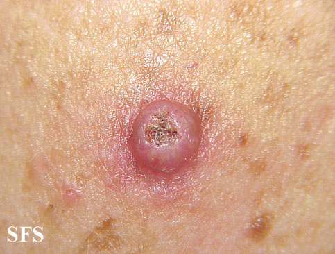 File:Keratoacanthoma (Dermatology Atlas 22).jpg