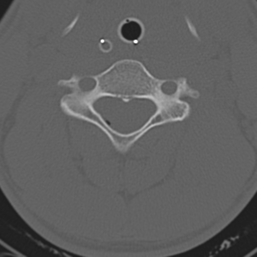 File:Multitrauma with diffuse axonal injury, temporal bone fractures and traumatic caroticocavernous fistula (Radiopaedia 37242-39035 Axial 179).png