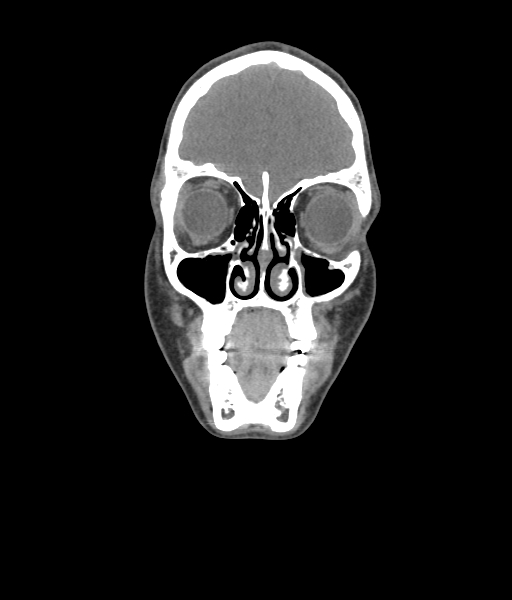 File:Nasal pyogenic granuloma (lobular capillary hemangioma) (Radiopaedia 85536-101244 Coronal non-contrast 66).jpg