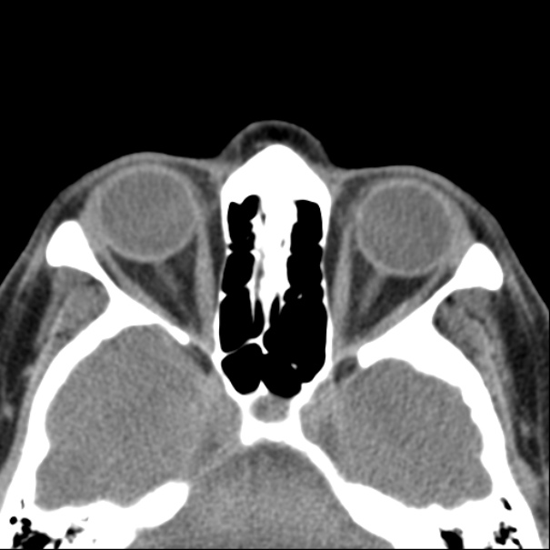 Nasolabial cyst (Radiopaedia 33987-35205 Axial non-contrast 35).jpg