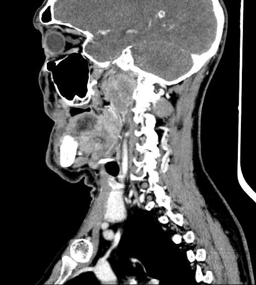 File:Nasopharyngeal carcinoma - infiltrating the clivus (Radiopaedia 62583-70875 C 19).jpg